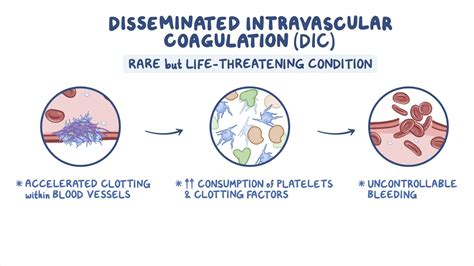 Acute Disseminated Intravascular Coagulation (DIC).